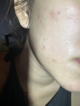 Trị mụn hiệu quả