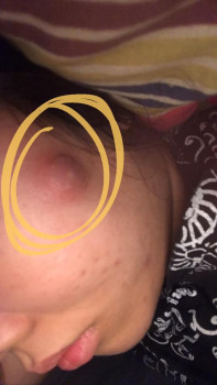 Mụn siêu to, khổng lồ