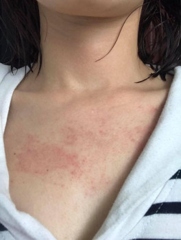 CÁCH NGUYÊN TRỊ MỤN Ở NGỰC VÀ LƯNG