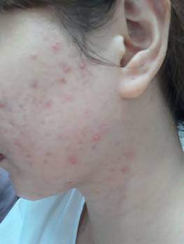 SẢN PHẨM TRỊ MỤN CHO DA NHẠY CẢM