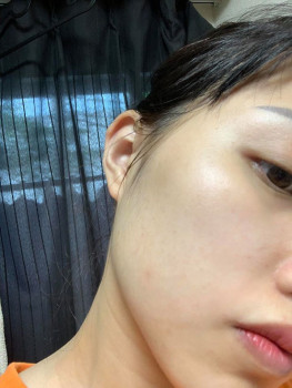 Nổi mụn lấm tấm ở trán và cằm phải làm sao?