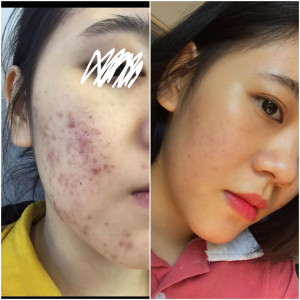 9 Tháng trị mụn dạy mình điều gì?