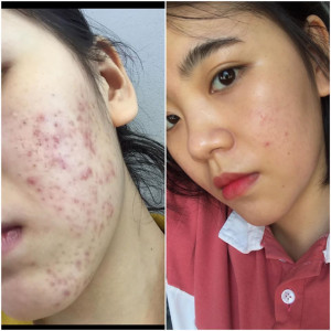9 Tháng trị mụn dạy mình điều gì?