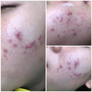 9 Tháng trị mụn dạy mình điều gì?