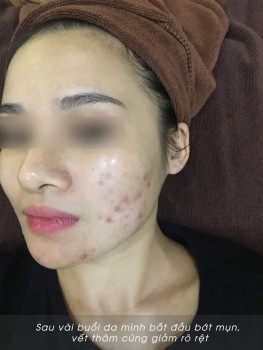 Mình đã điều trị dứt điểm mụn sưng viêm lâu năm như thế nào?
