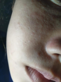 Skincare chưa đúng khiến mặt nổi mụn
