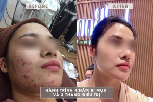 Mình đã điều trị dứt điểm mụn sưng viêm lâu năm như thế nào?
