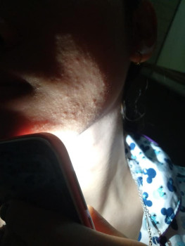 Skincare chưa đúng khiến mặt nổi mụn