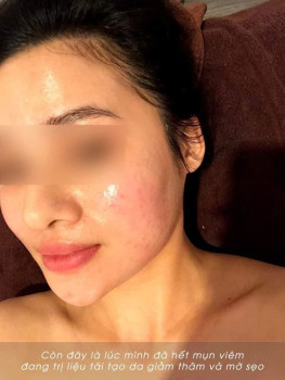 Mình đã điều trị dứt điểm mụn sưng viêm lâu năm như thế nào?