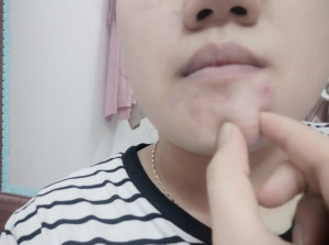 Stress kinh khủng về mụn ở cằm, toàn mụn to đùng, rắn, đau.