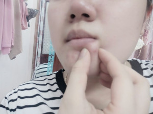 Stress kinh khủng về mụn ở cằm, toàn mụn to đùng, rắn, đau.