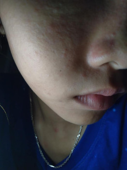 Skincare chưa đúng khiến mặt nổi mụn