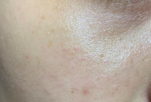 Cách chăm sóc da bị nám nhẹ