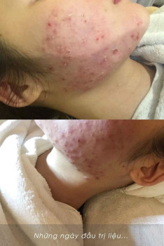 Mình đã điều trị dứt điểm mụn sưng viêm lâu năm như thế nào?