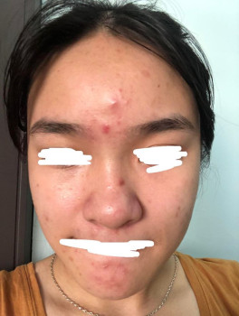 Giúp bạn đang bị stress vì mặt mụn