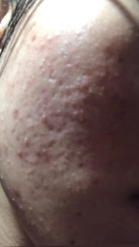 Phương pháp chăm sóc cho da mặt bị mụn nặng