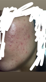 Phương pháp chăm sóc cho da mặt bị mụn nặng
