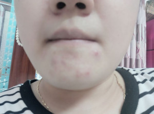 Stress kinh khủng về mụn ở cằm, toàn mụn to đùng, rắn, đau.