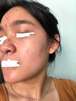 Giúp bạn đang bị stress vì mặt mụn