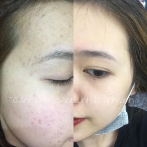 Chu trình dưỡng da cho mặt mụn