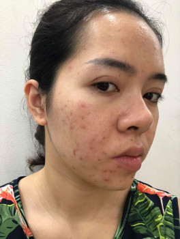 Hành trình giải cứu cho làn da đang căng bóng trở nên nhạy cảm và nhiều mụn