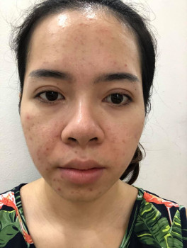 Hành trình giải cứu cho làn da đang căng bóng trở nên nhạy cảm và nhiều mụn