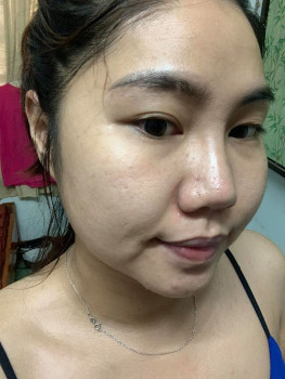 Mình đã trị mụn ẩn và thâm mụn như thế nào?? 