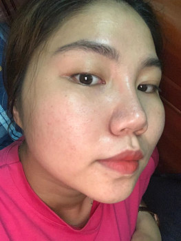 Mình đã trị mụn ẩn và thâm mụn như thế nào?? 
