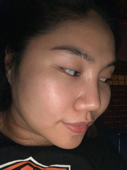 Mình đã trị mụn ẩn và thâm mụn như thế nào?? 