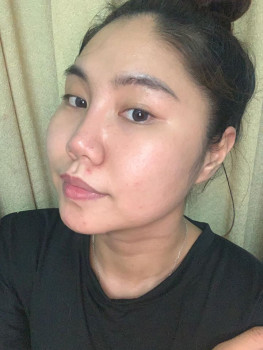 Mình đã trị mụn ẩn và thâm mụn như thế nào?? 
