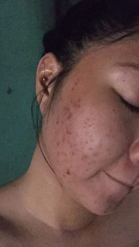 Mình đã trị mụn ẩn và thâm mụn như thế nào?? 