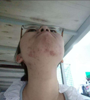Từng bị chê bai vì má đầy mụn, cô gái đã thay đổi như thế này đây
