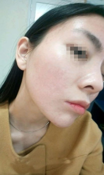 Vì mặt mụn tôi không dám yêu ai