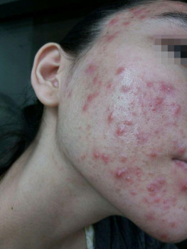 Vì mặt mụn tôi không dám yêu ai