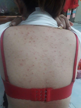 “Thoát kiếp FA” một cách ngoạn mục của cô gái "mụn lưng"