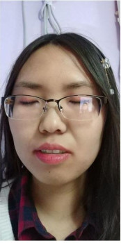 Từng bị chê bai vì má đầy mụn, cô gái đã thay đổi như thế này đây