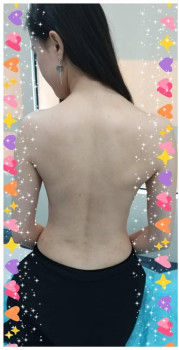 Từ cô nàng mụn lưng hóa thành hot girl gợi cảm nhờ đâu?