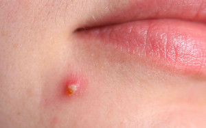 Cách trị mụn bọc bằng mẹo cực đơn giản tại nhà