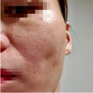 DR THÁP LONG CHIA SẺ MỘT SỐ TRƯỜNG HỢP CÓ THỂ GẶP PHẢI SAU CĂNG CHỈ
