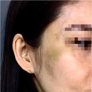 DR THÁP LONG CHIA SẺ MỘT SỐ TRƯỜNG HỢP CÓ THỂ GẶP PHẢI SAU CĂNG CHỈ