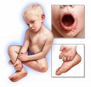 Phải làm gì khi bé bị chân tay miệng?