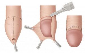Những điều cần biết về cắt bao quy đầu