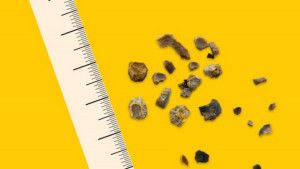 Các triệu chứng của sỏi struvite – loại sỏi thận ít gặp