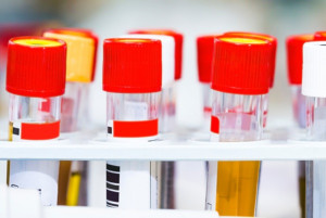 Chỉ số kali niệu bao nhiêu là bình thường?