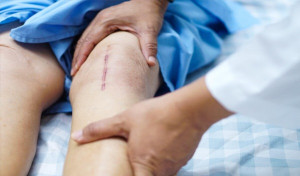 Cách giảm đau, sưng tấy và bầm tím sau phẫu thuật thay khớp gối toàn phần