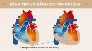 10 câu hỏi về bệnh cơ tim phì đại