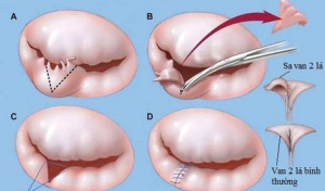 Điều trị sa van hai lá như thế nào?