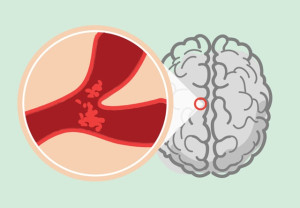 Giảm nguy cơ đột quỵ sau cơn thiếu máu não thoáng qua