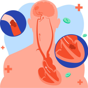 Mối liên hệ giữa hội chứng ngưng thở khi ngủ và rung nhĩ