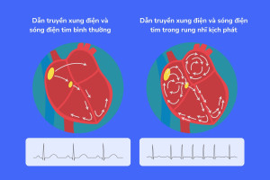Những điều cần biết về các loại rung nhĩ